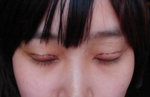 韓式雙眼皮效果是永久的嗎