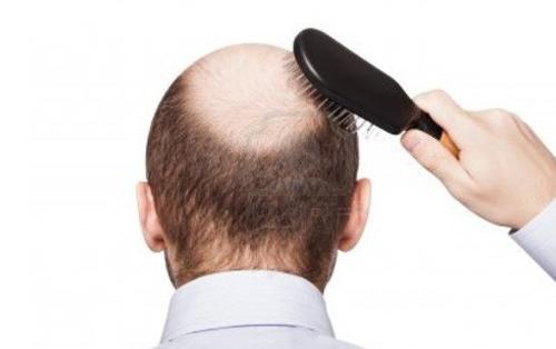 解除男人脫髮煩惱的五個方法