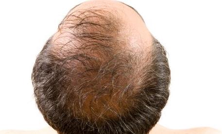 男人脫髮暗示4種疾病